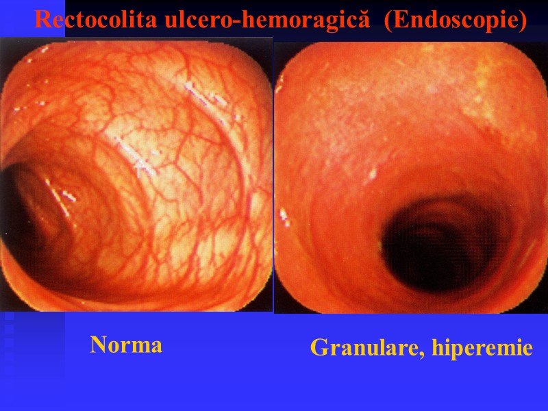 Rectocolita ulcero-hemoragică  (Endoscopie) Norma Granulare, hiperemie